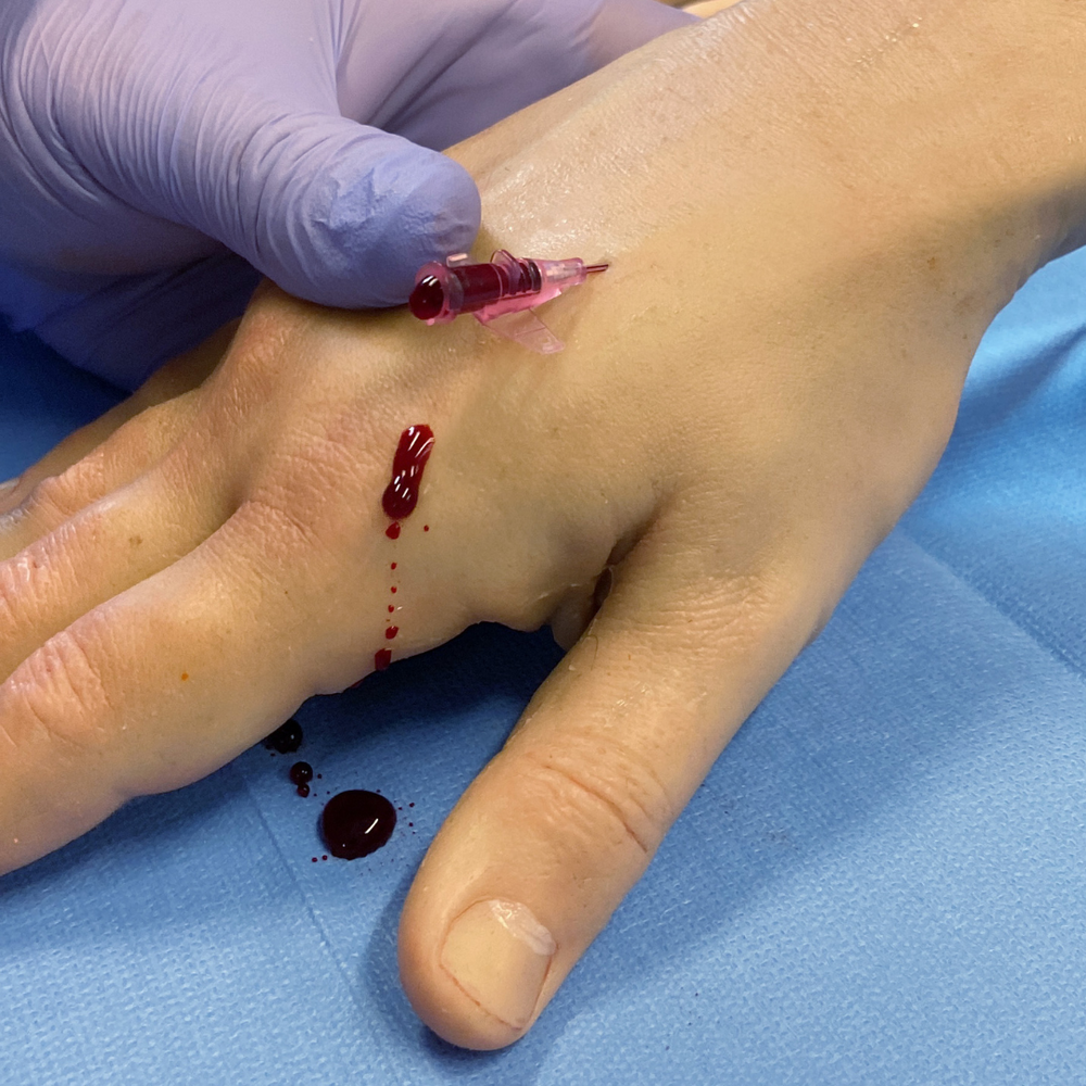 Hyper-Realistic IV Arm Puncture Pete | Light Skin | EZ-7710 | Sim & Skills Ltd