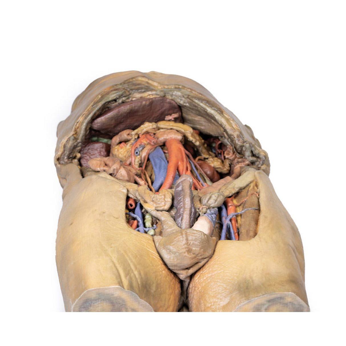 Abdomen with bilateral Hernias | EZ-MP1130 | Sim & Skills Ltd