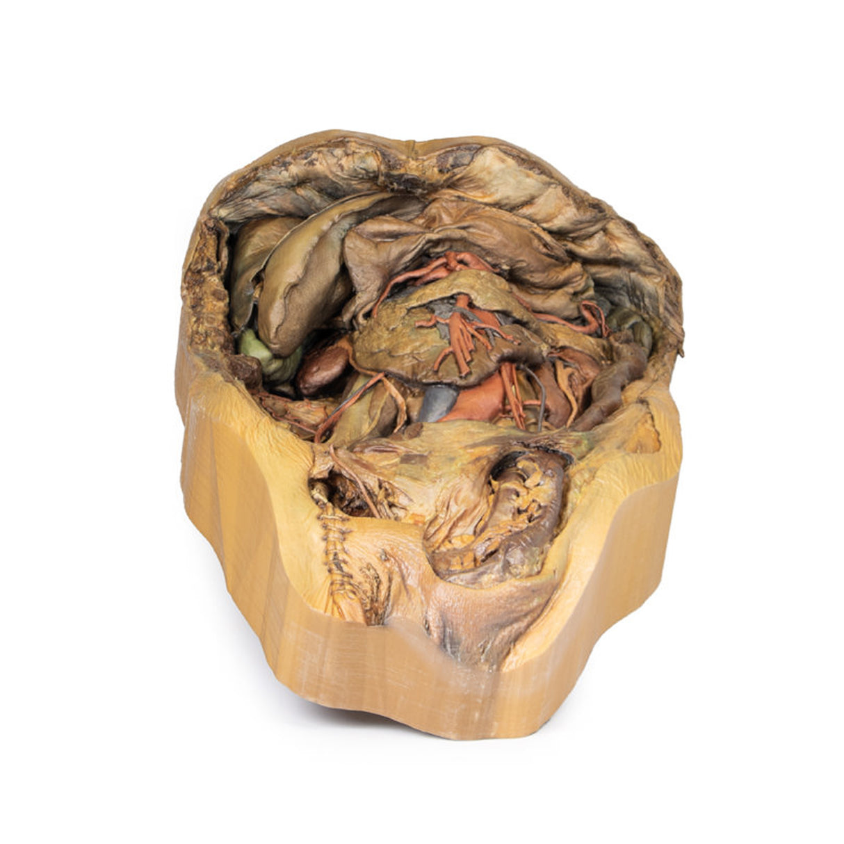 Abdomen with inguinal hernia | EZ-MP1133 | Sim & Skills Ltd