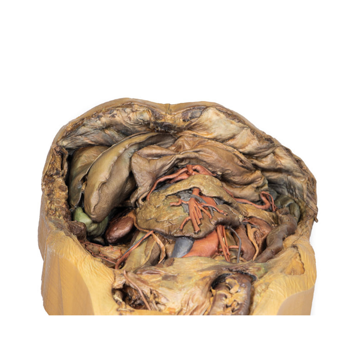 Abdomen with inguinal hernia | EZ-MP1133 | Sim & Skills Ltd