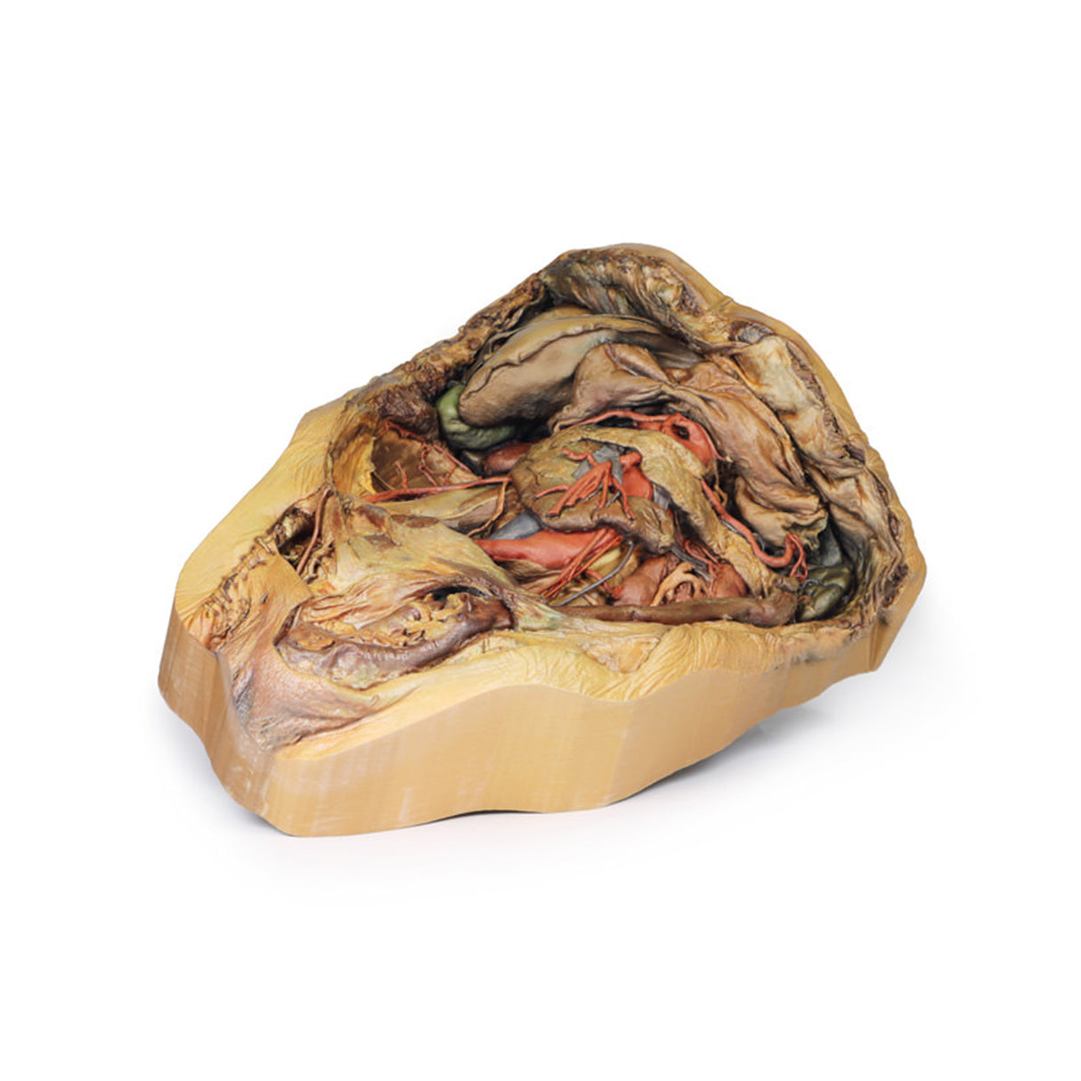 Abdomen with inguinal hernia | EZ-MP1133 | Sim & Skills Ltd