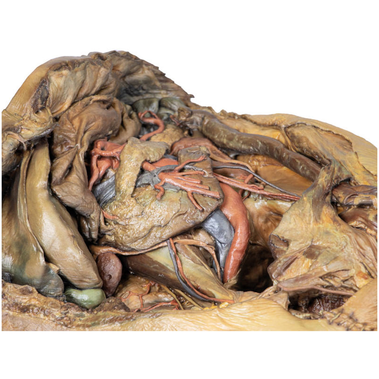 Abdomen with inguinal hernia | EZ-MP1133 | Sim & Skills Ltd