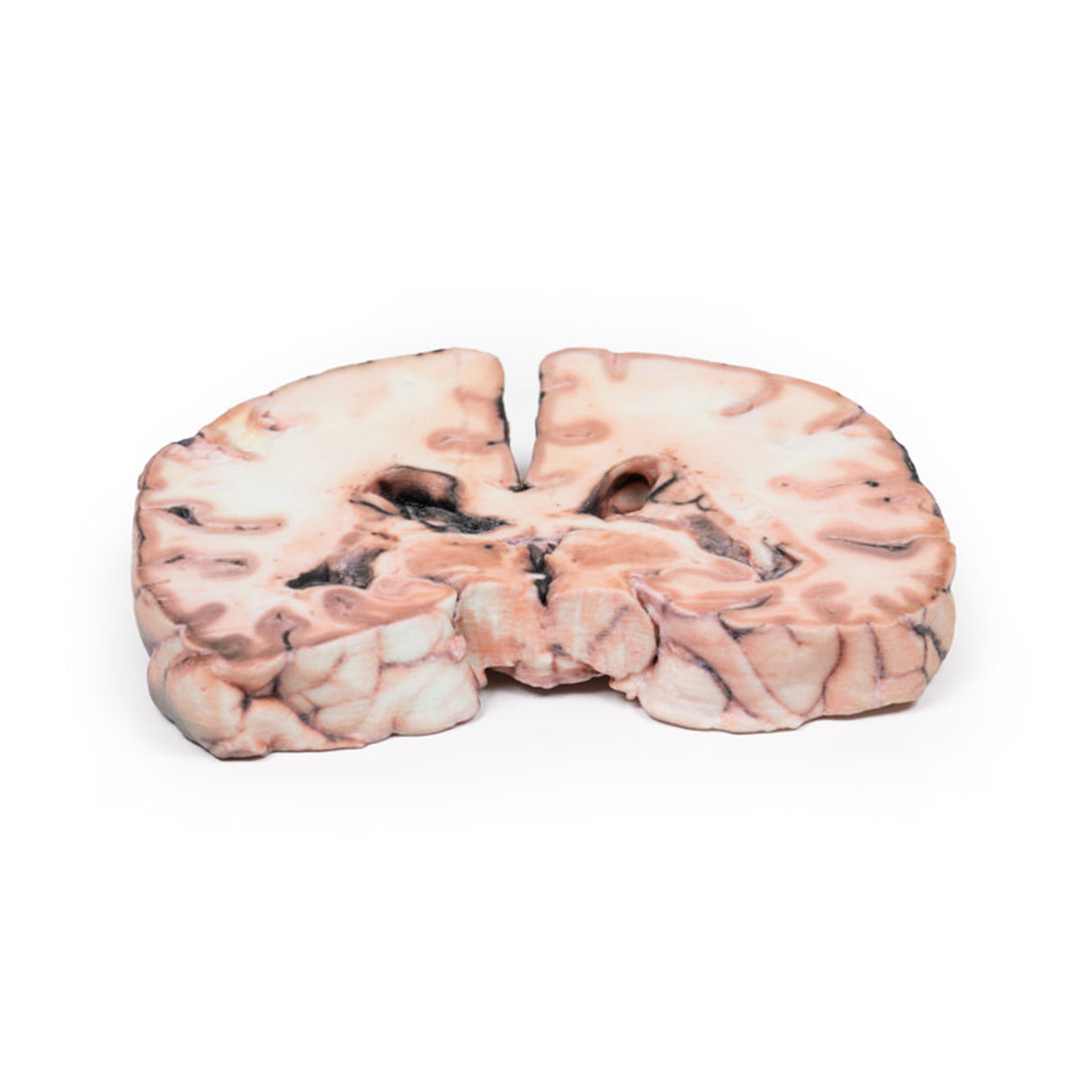 Glioma grade 3-4, causing papilloedema | EZ-2003 | Sim & Skills Ltd