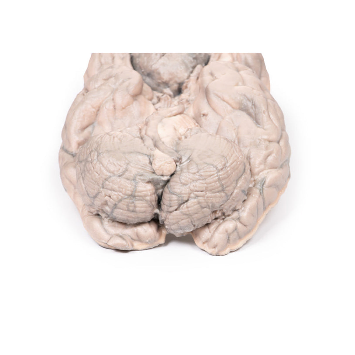 Meningioma | EZ-MP2004 | Sim & Skills Ltd