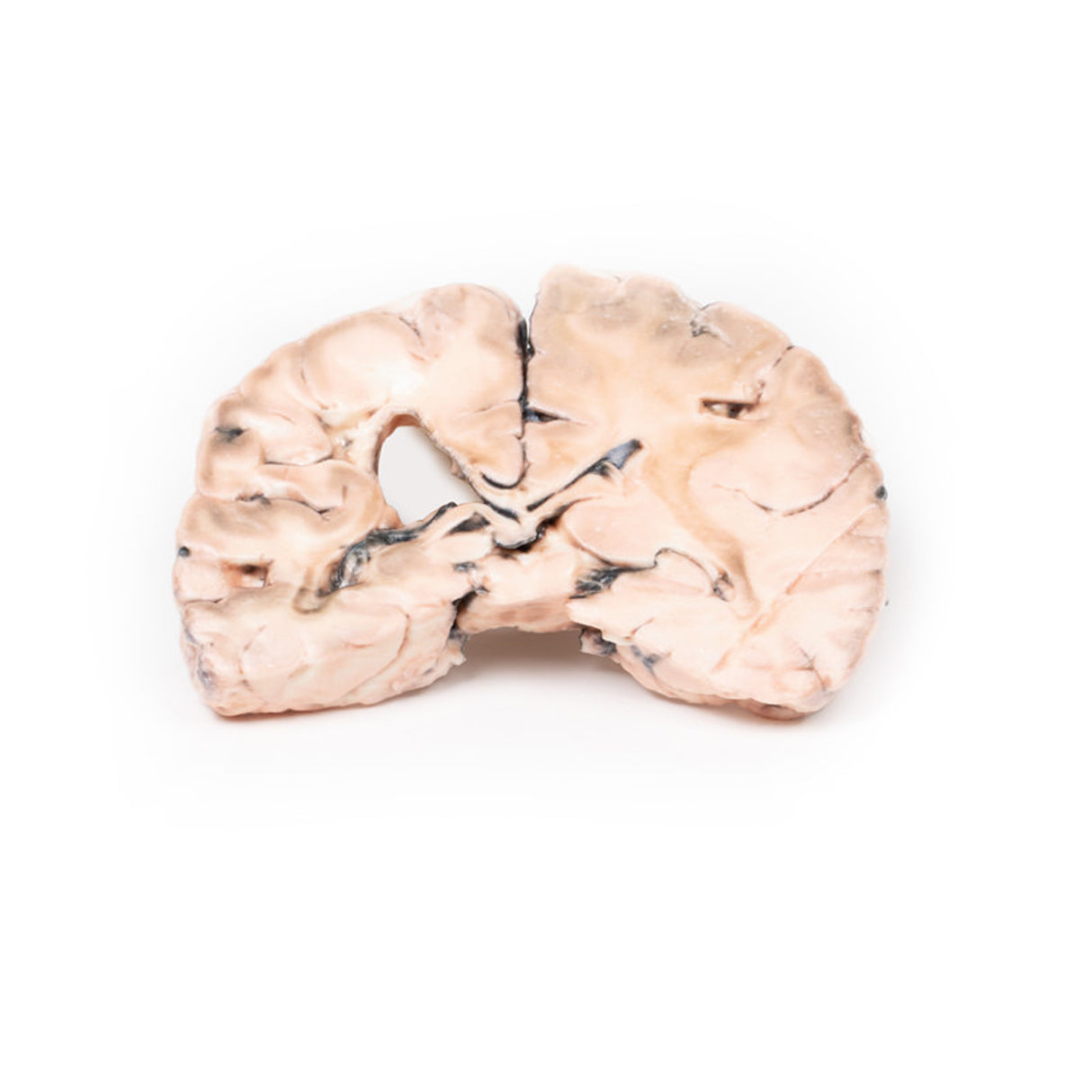 Left cerebral infarct | EZ-MP2005 | Sim & Skills Ltd