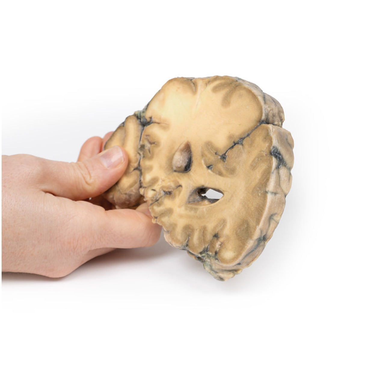 Metastatic Adenocarcinoma in the Brain | EX-MP2007 | Sim & Skills Ltd