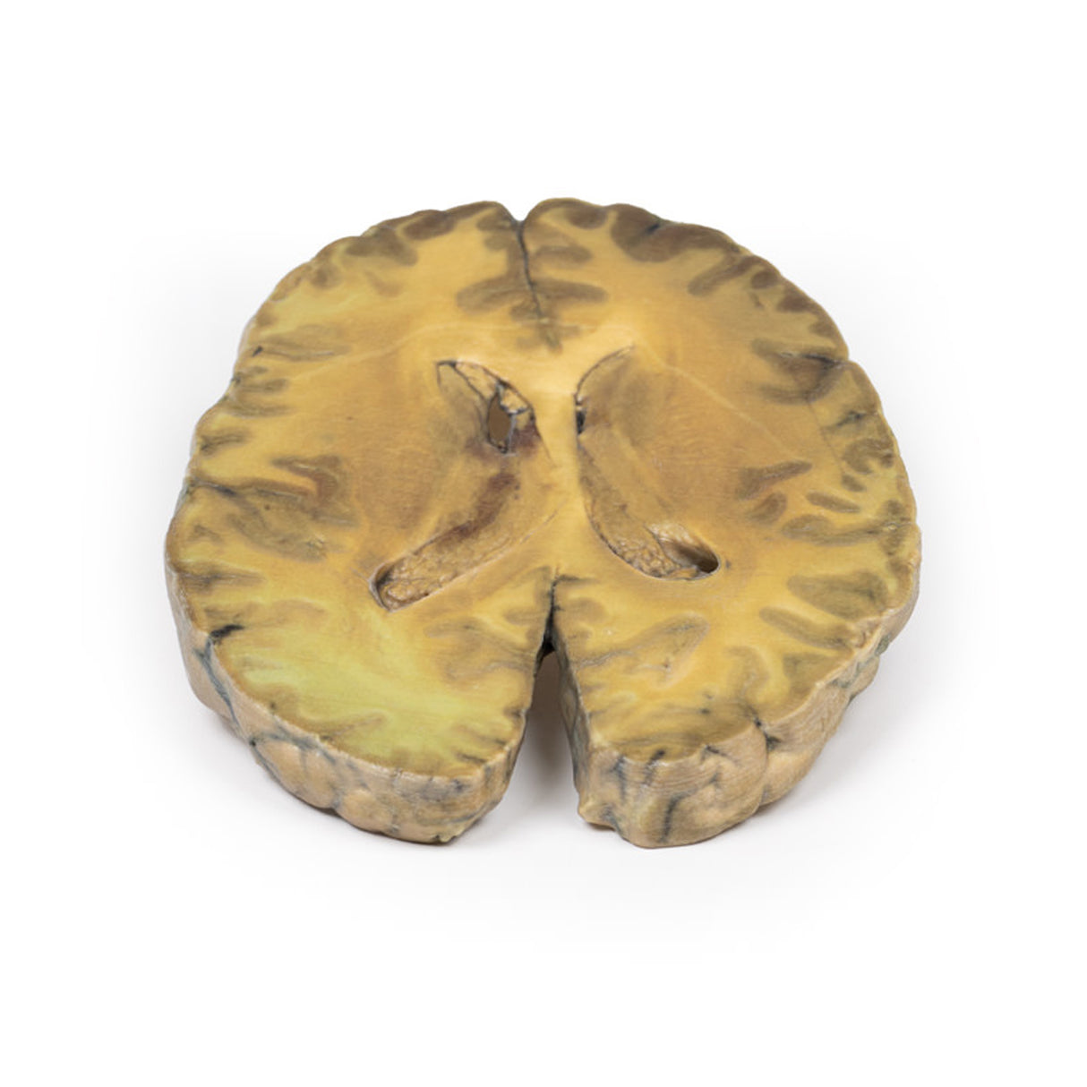 Ventriculitis, Secondary to Septicaemia | EZ-MP2008 | Sim & Skills Ltd