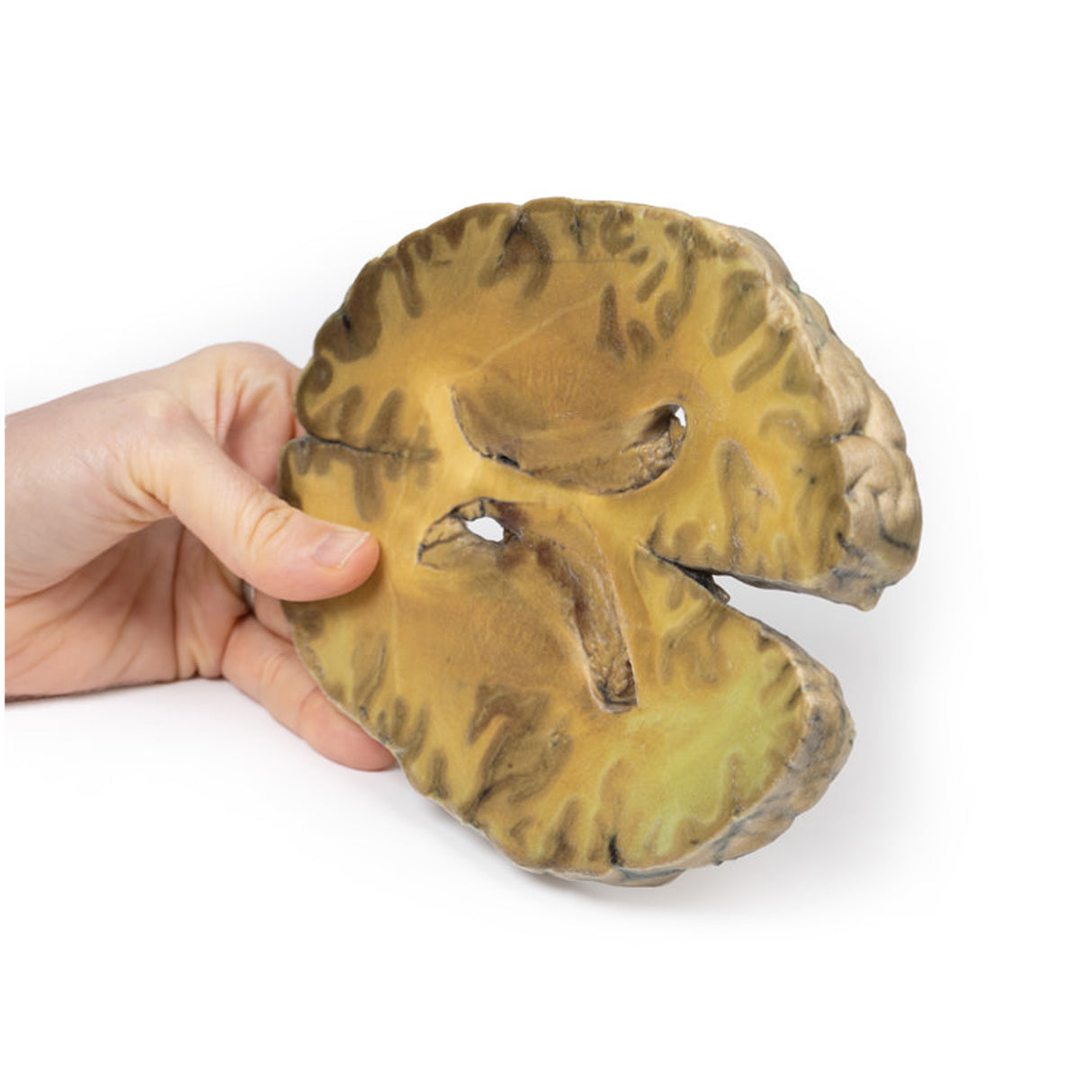 Ventriculitis, Secondary to Septicaemia | EZ-MP2008 | Sim & Skills Ltd