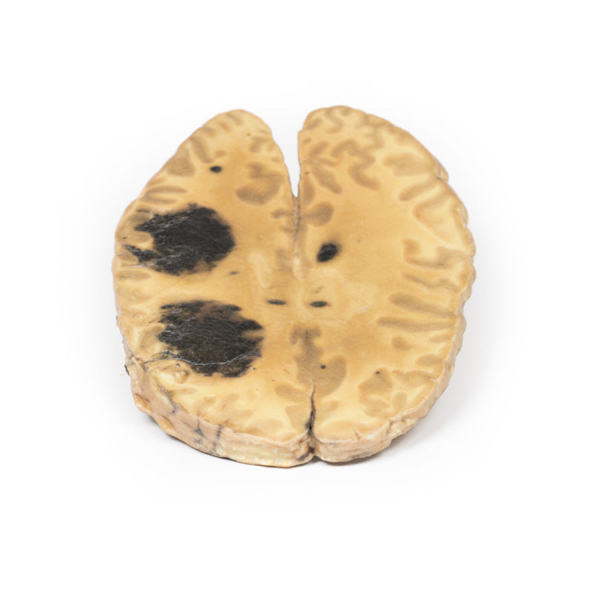 Cerebral Haemorrhage, secondary to Acute Myeloid Leukaemia | EZ-MP2009 | Sim & Skills Ltd