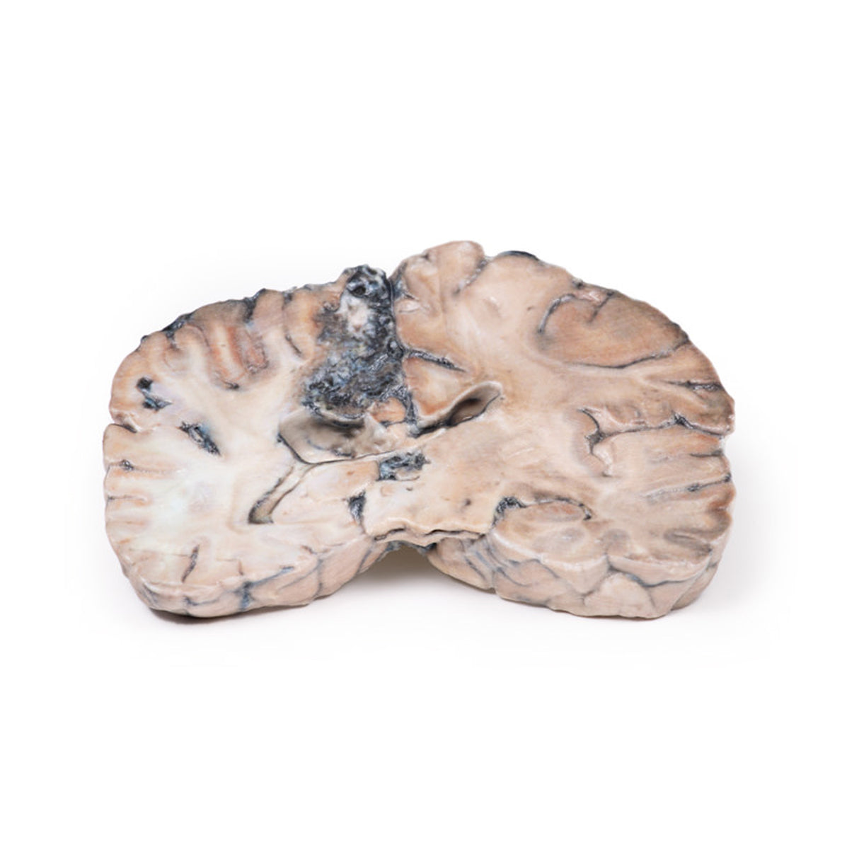 Cerebral Arterio-Venous Malformation | EZ-MP2010 | Sim & Skills Ltd