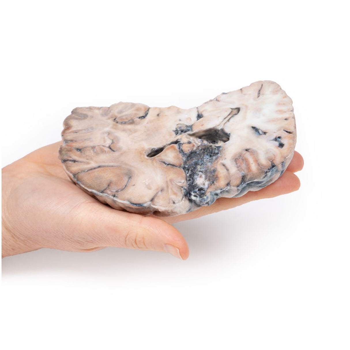 Cerebral Arterio-Venous Malformation | EZ-MP2010 | Sim & Skills Ltd