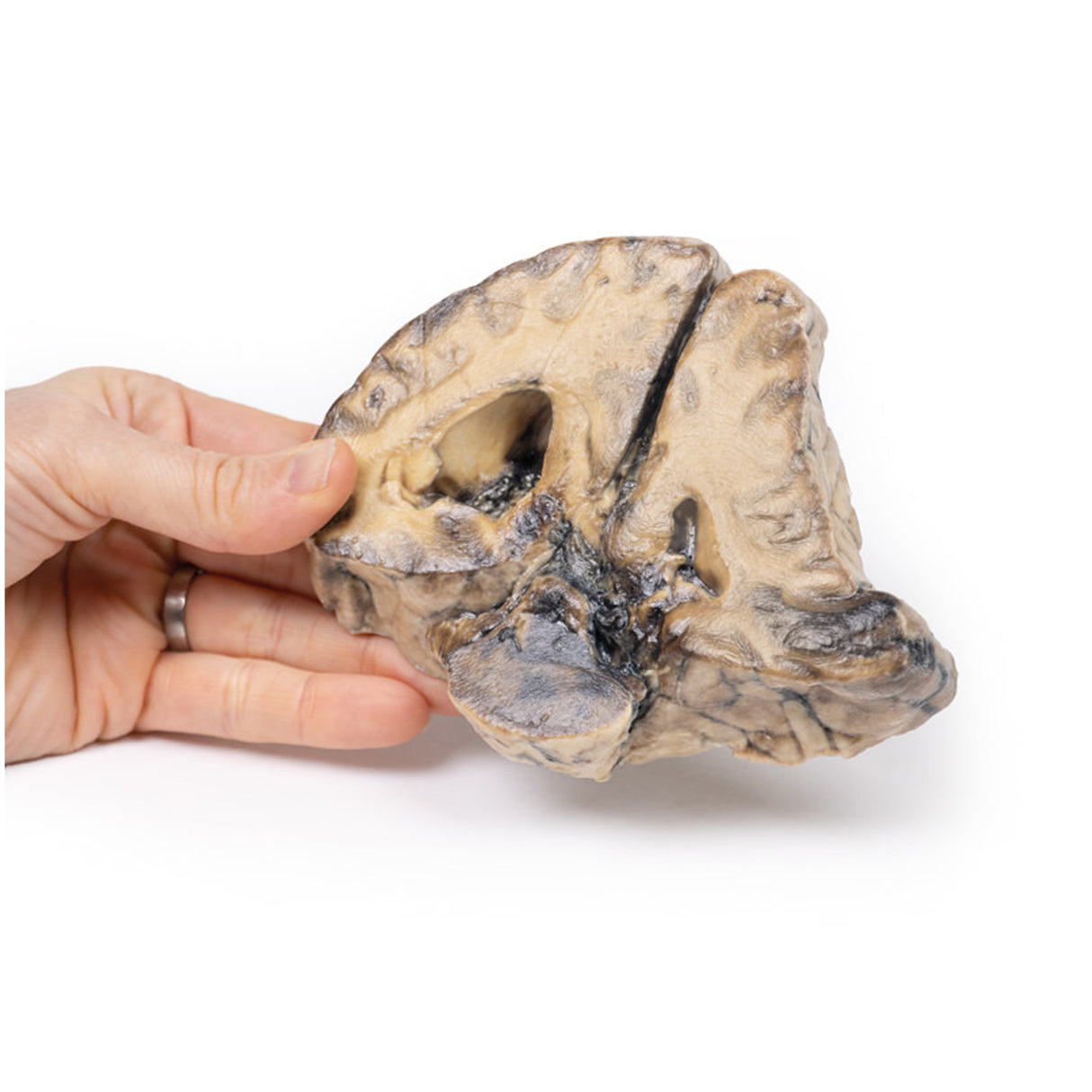 Intracranial space-occupying lesion | EZ-MP2011 | Sim & Skills Ltd