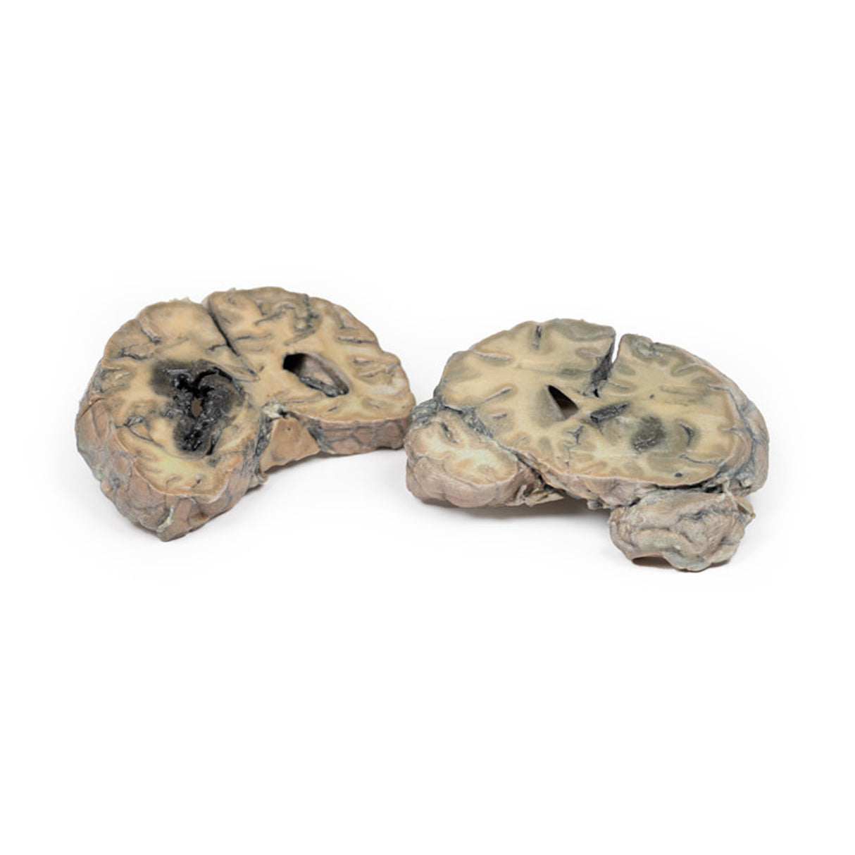 Intracerebral Haemorrhage | EZ-MP2012 | Sim & Skills Ltd