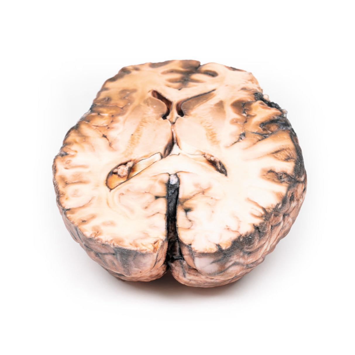 Ruptured Berry Aneurysm | EZ-MP2013 | Sim & Skills Ltd