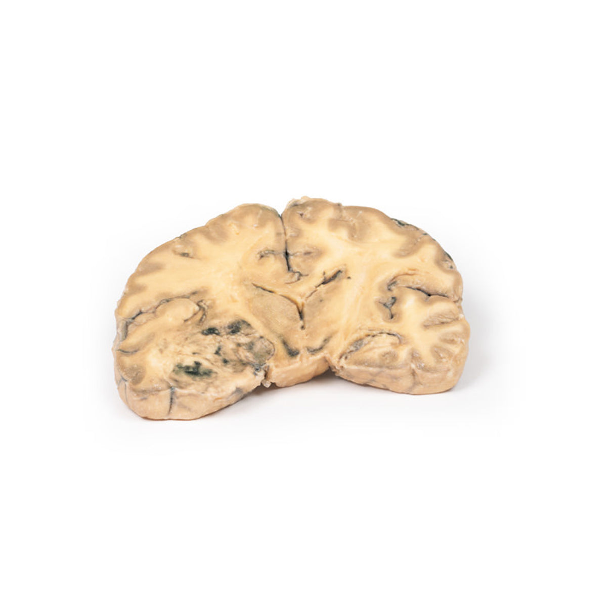 Astrocytoma | EZ-MP2014 | Sim & Skills Ltd
