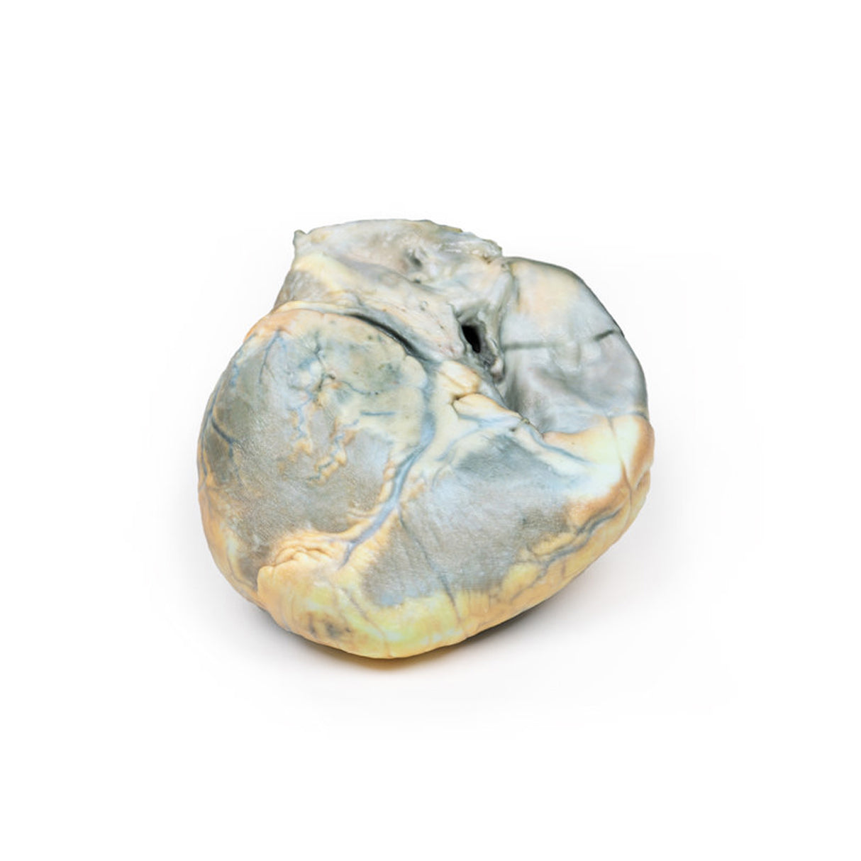 Right Ventricular Hypertrophy | EZ-MP2031 | Sim & Skills Ltd