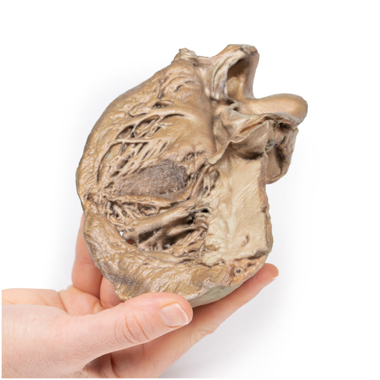 Bicuspid Aortic Valve | EZ-MP2033 | Sim & Skills Ltd