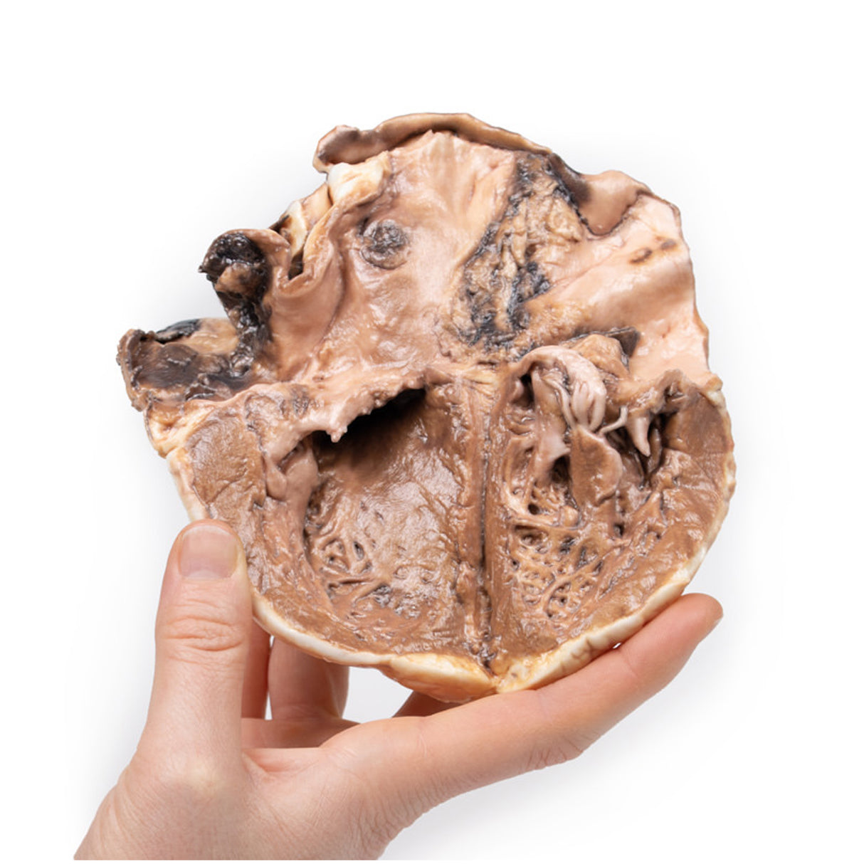 Rheumatic endocarditis | EZ-MP2039 | Sim & Skills Ltd