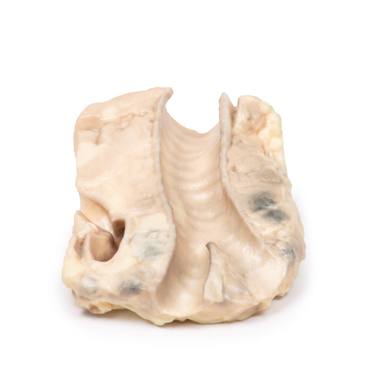 Trachea—Hodgkin Lymphoma | EZ-MP2062 | Sim & Skills Ltd