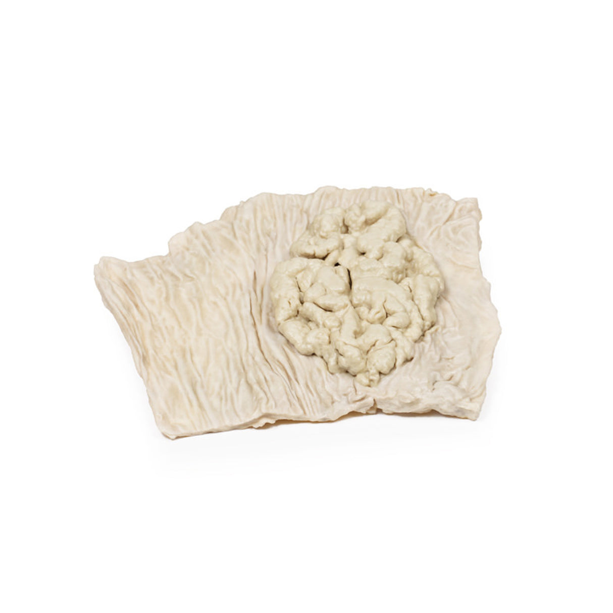 Villous adenoma of colon | EZ-MP2071 | Sim & Skills Ltd