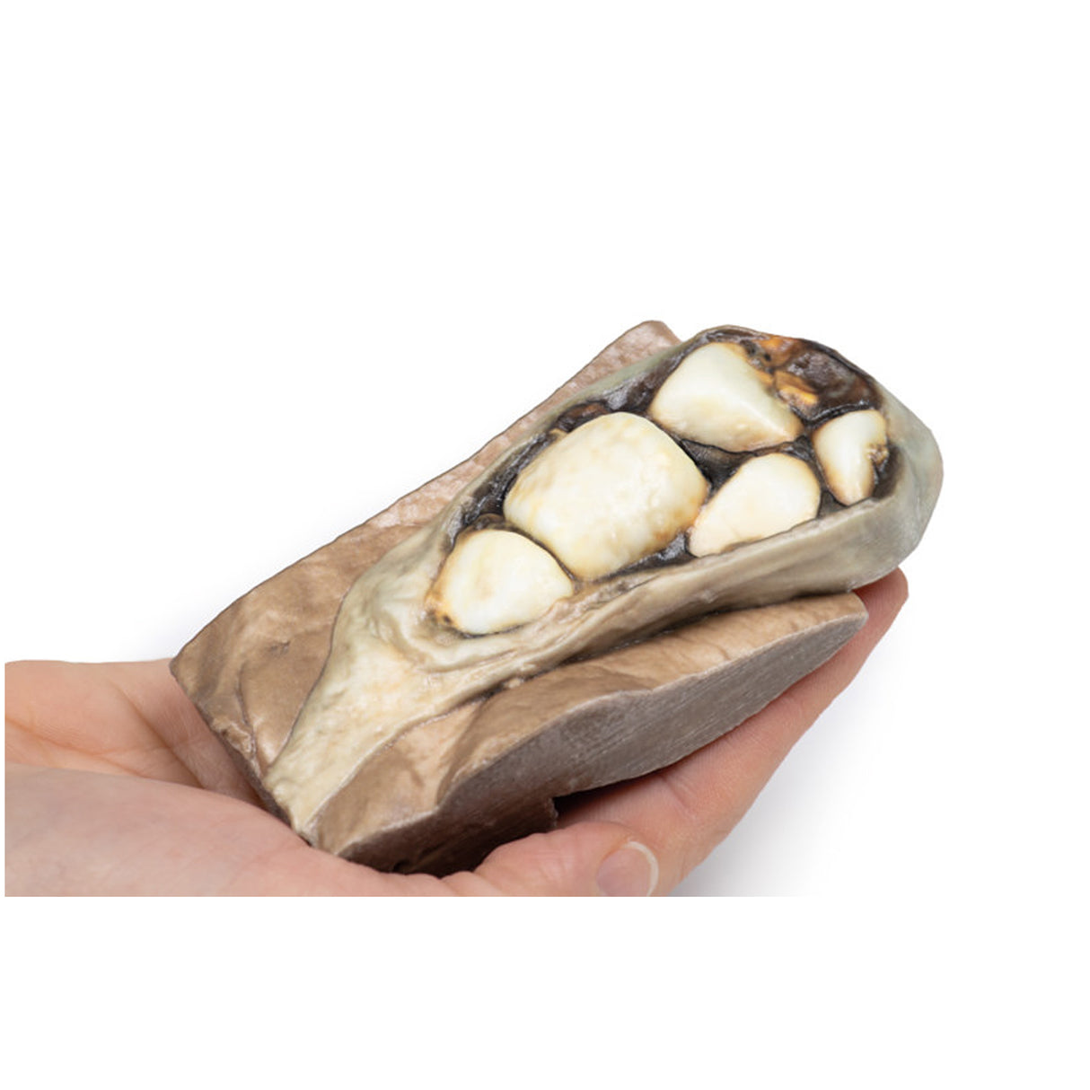 Cholelithiasis (Gallstones) | EZ-MP2075 | Sim & Skills Ltd