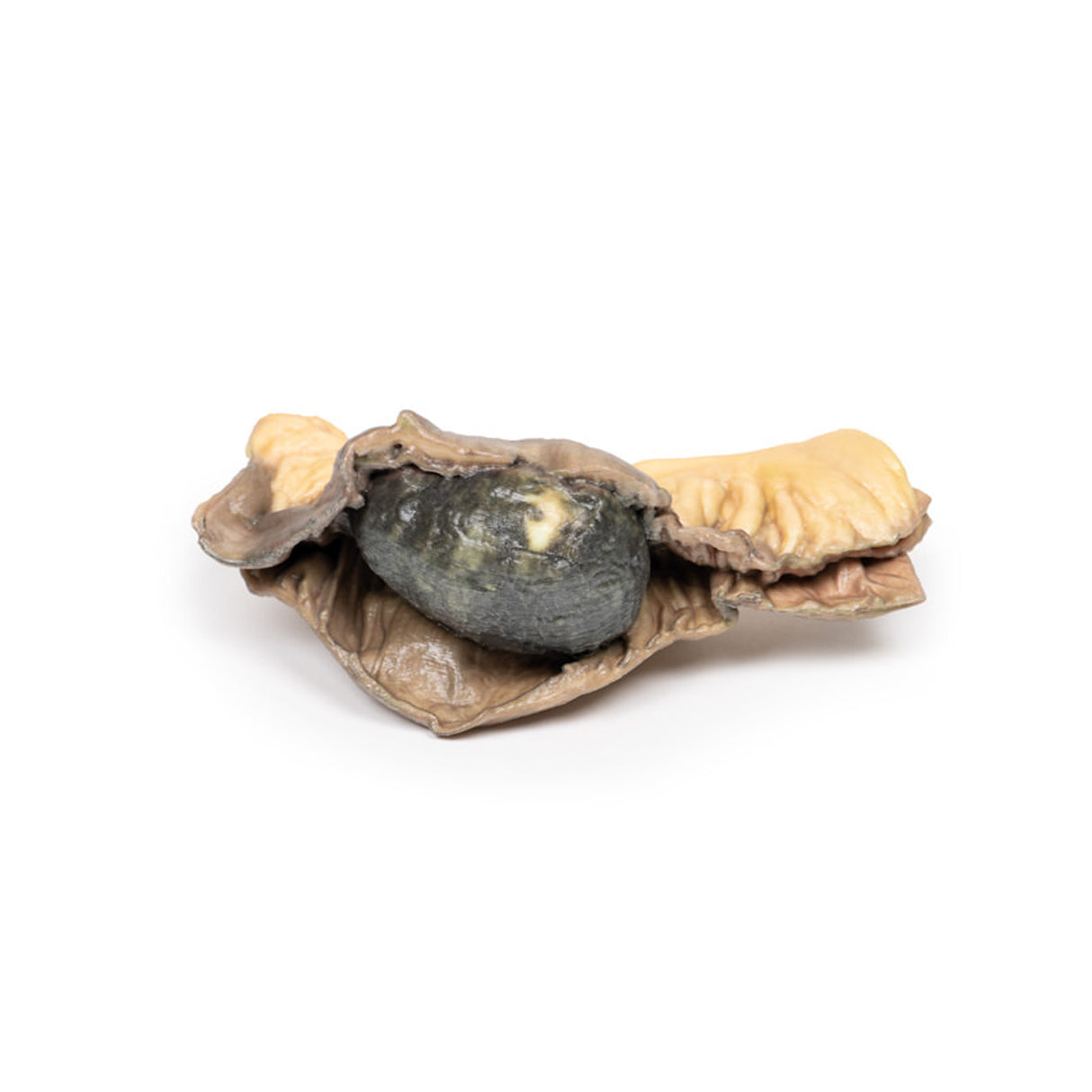 Gallstone Ileus | EZ-MP2078 | Sim & Skills Ltd