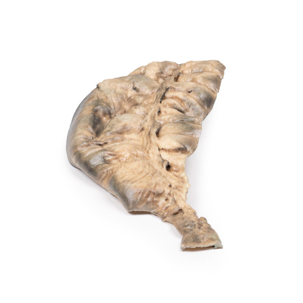 Hirschsprung's Disease | EZ-MP2079 | Sim & Skills Ltd