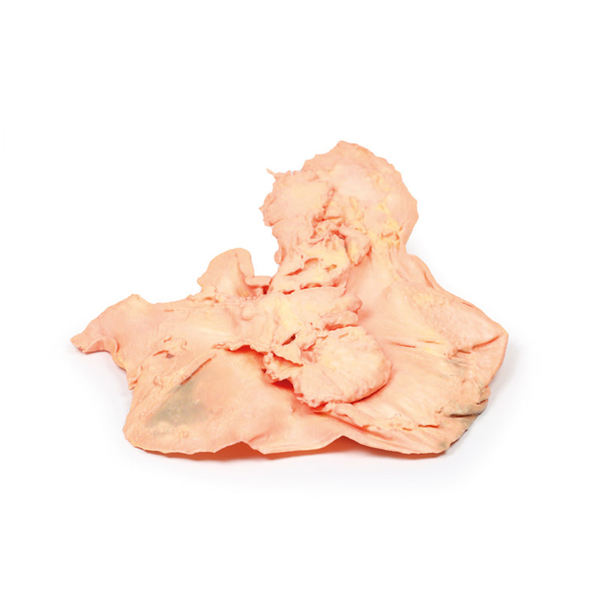 Adenocarcinoma of the stomach | EZ-MP2080 | Sim & Skills Ltd