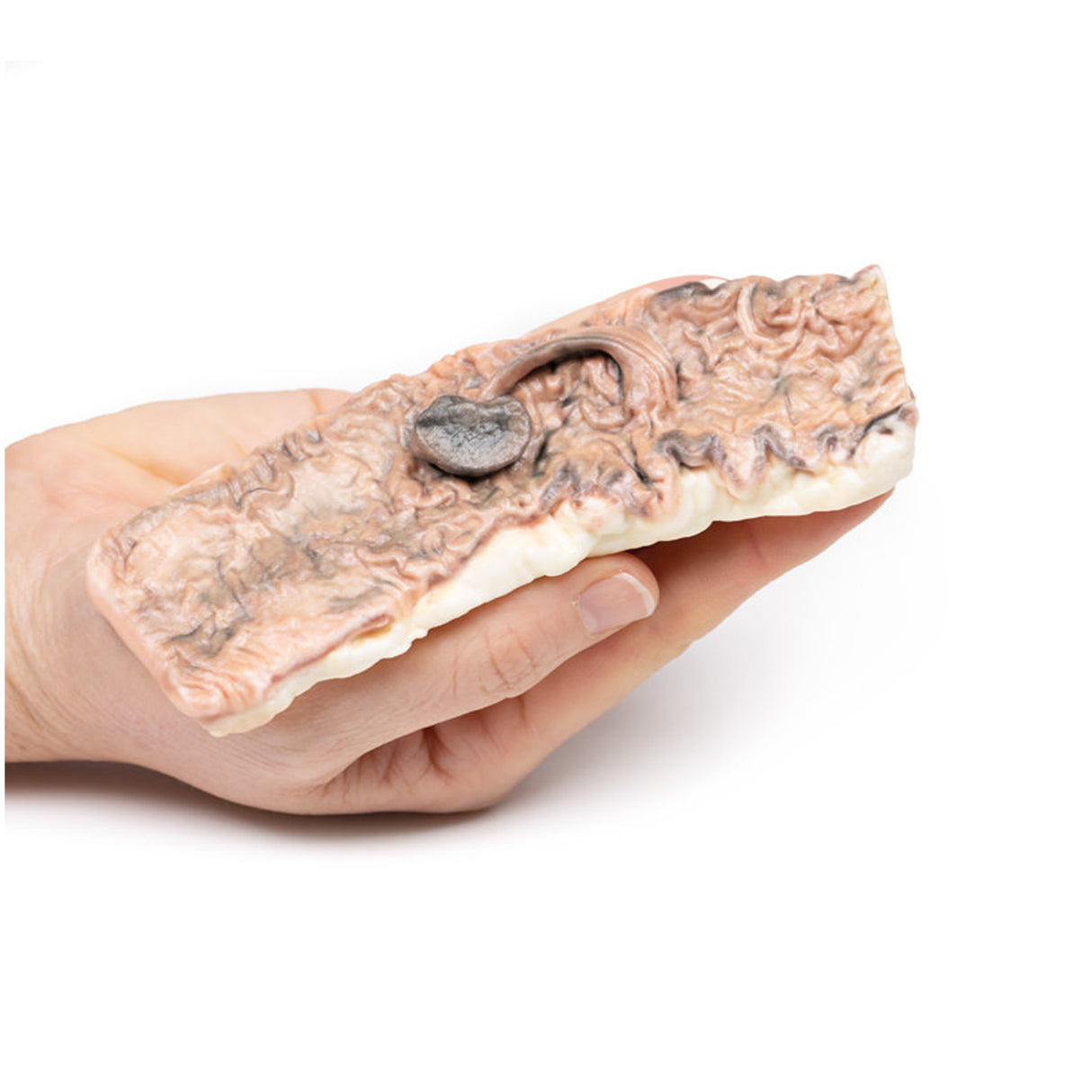 Pedunculated Adenoma of the Colon | EZ-MP2081 | Sim & Skills Ltd