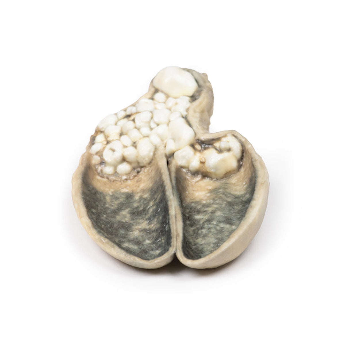 Cholecystitis and Cholelithiasis | EZ-MP2082 | Sim & Skills Ltd