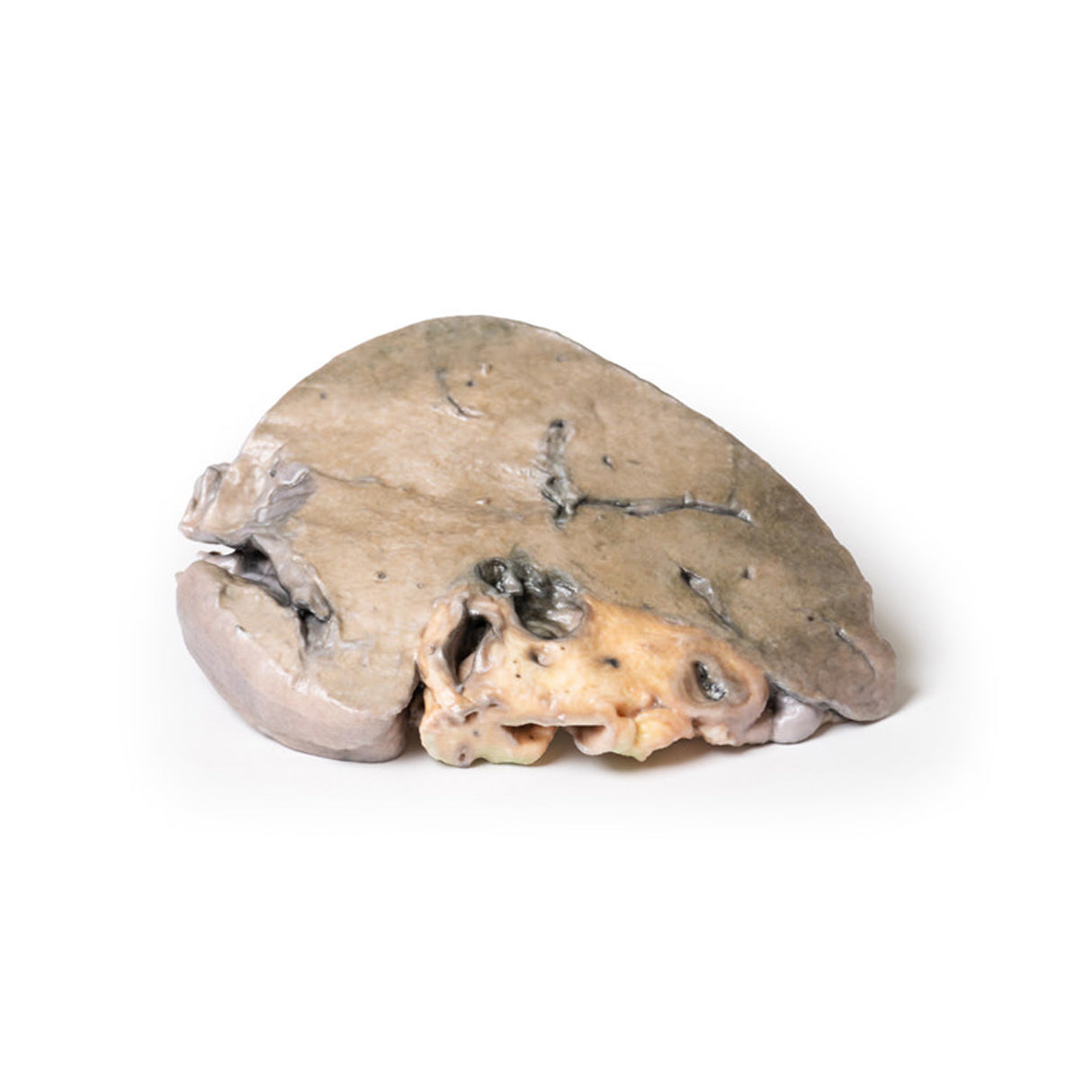 Hepatic duct calculi and Obstructive Biliary Cirrhosis | EZ-MP2084 | Sim & Skills Ltd