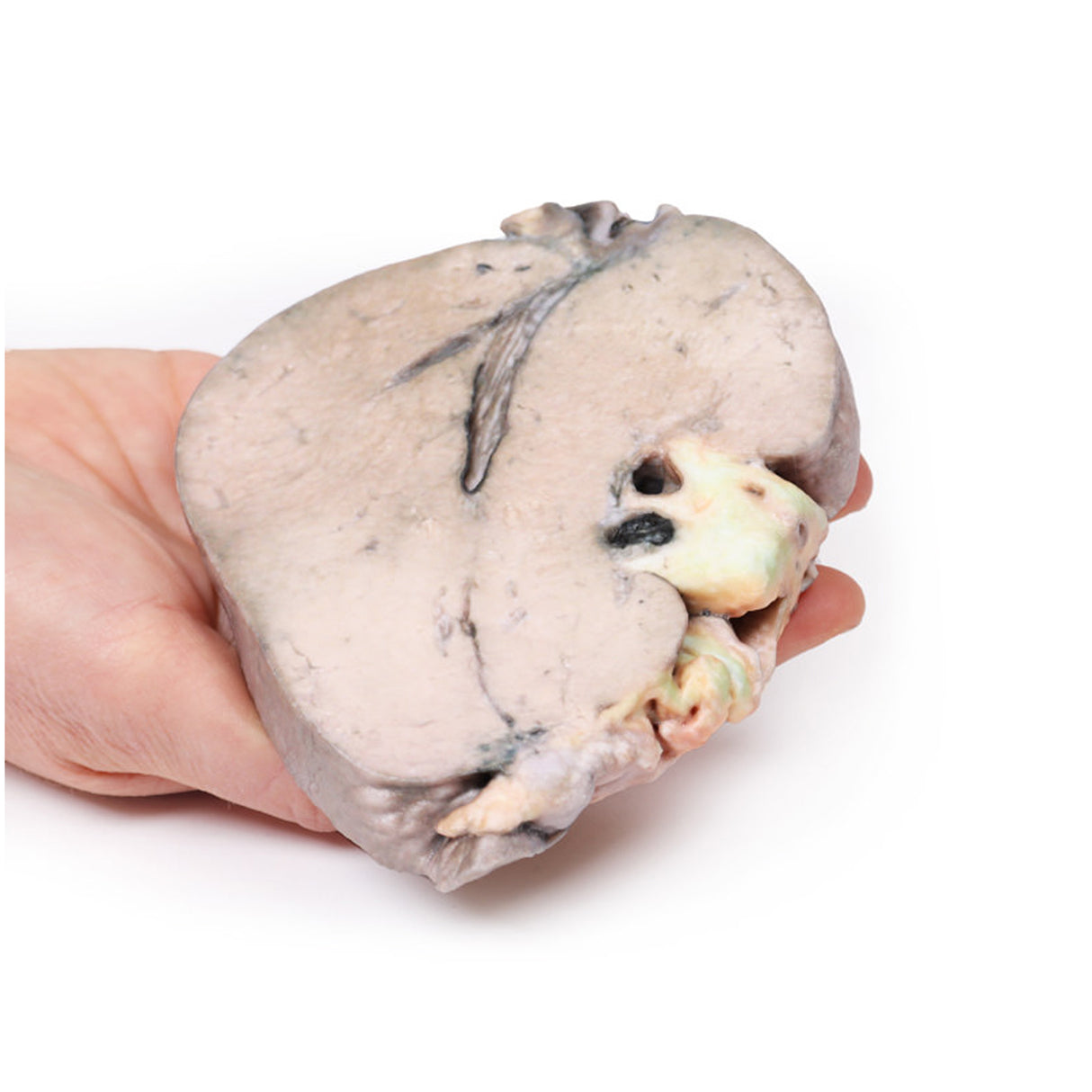 Hepatic duct calculi and Obstructive Biliary Cirrhosis | EZ-MP2084 | Sim & Skills Ltd