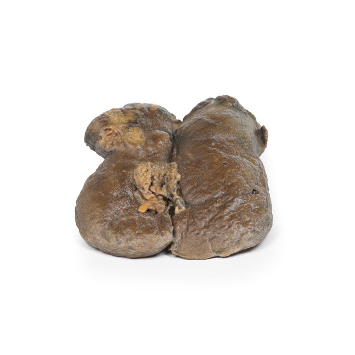 Renal Cell Carcinoma | EZ-MP2097 | Sim & Skills Ltd