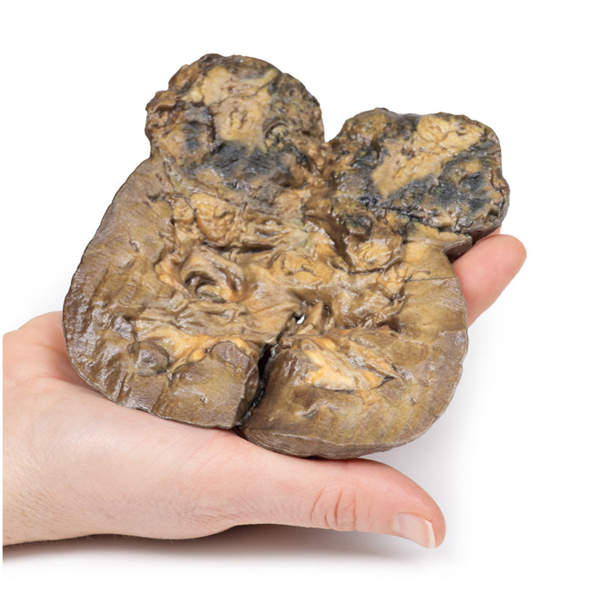 Renal Cell Carcinoma | EZ-MP2097 | Sim & Skills Ltd