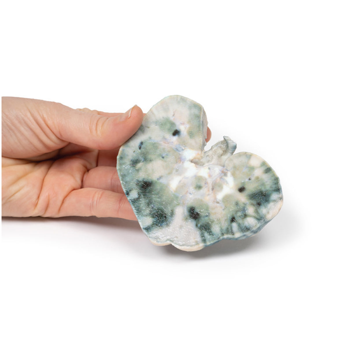 Septic Renal Infarct | EZ-MP2098 | Sim & Skills Ltd