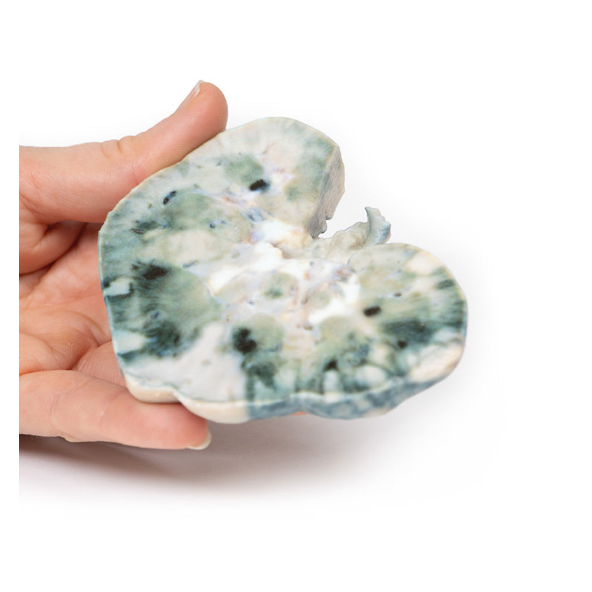 Septic Renal Infarct | EZ-MP2098 | Sim & Skills Ltd