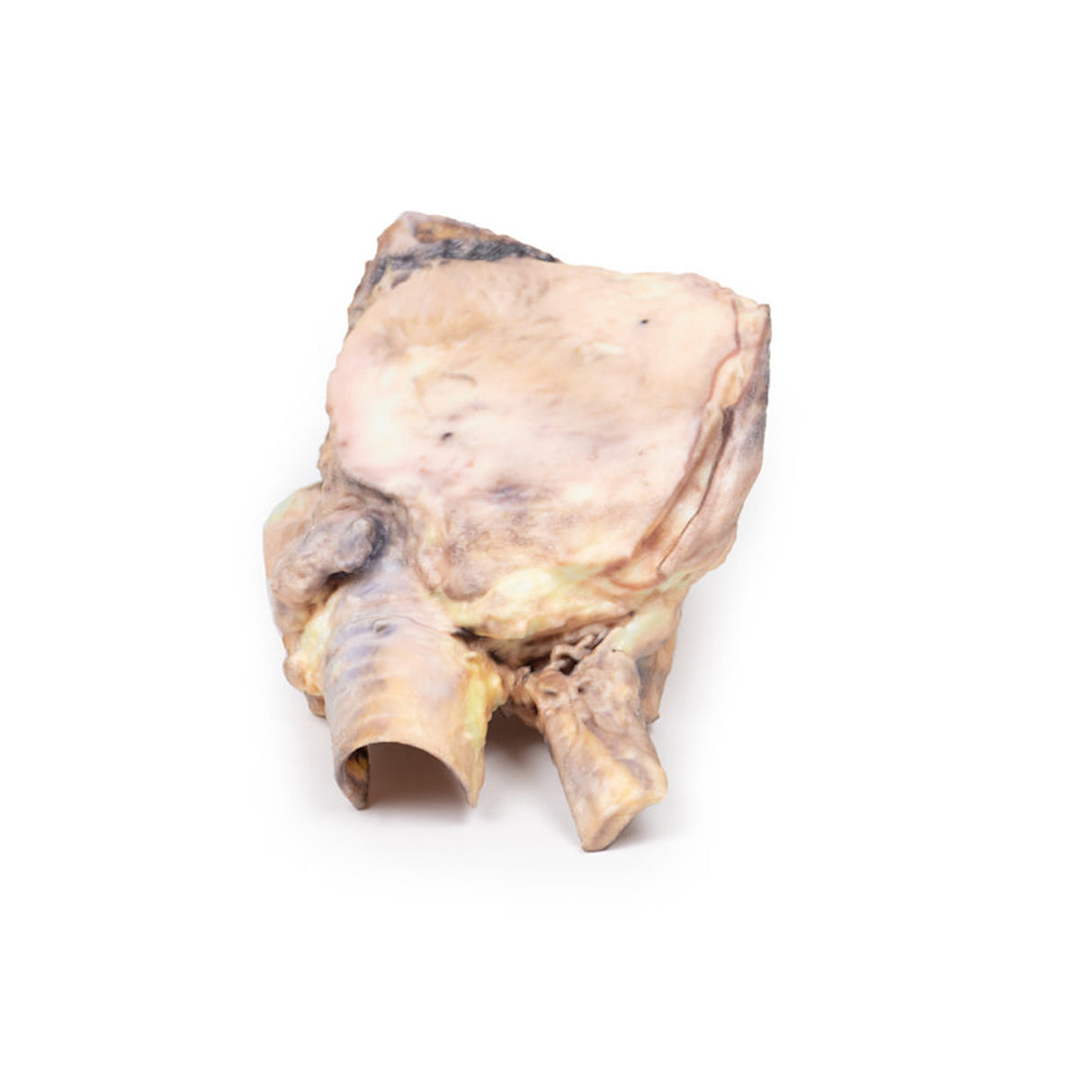 Lymphoma of the thyroid | EZ-MP2100 | Sim & Skills Ltd