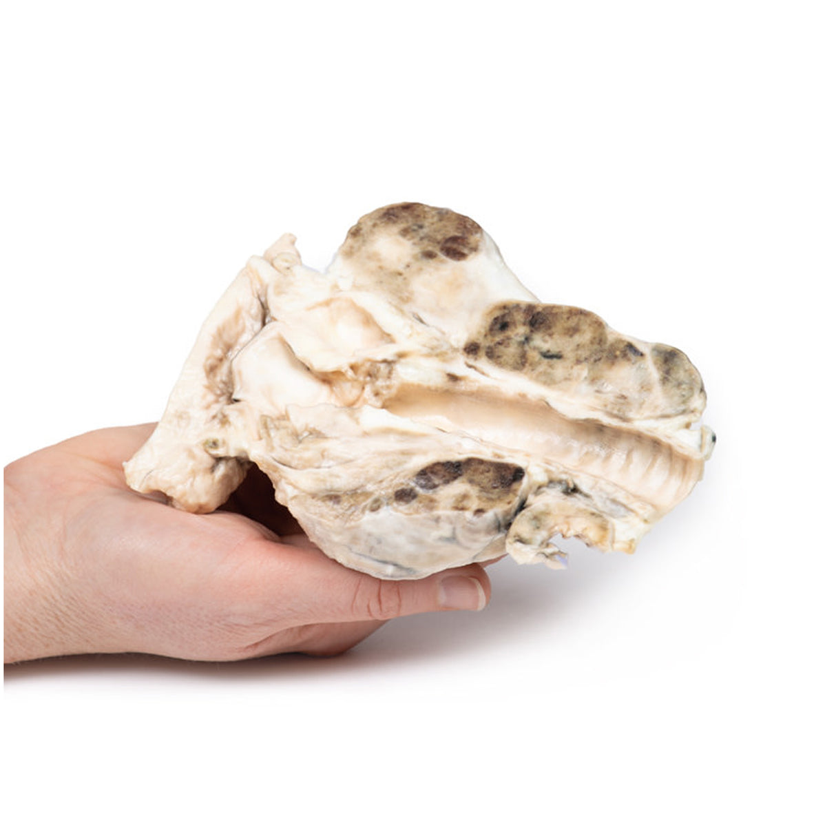 Multinodular goitre | EZ-MP2101 | Sim & Skills Ltd