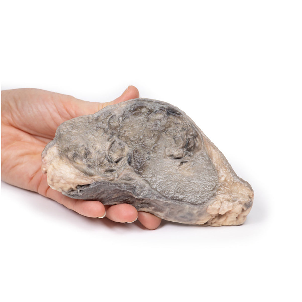 Carcinoma of Breast | EZ-MP2105 | Sim & Skills Ltd