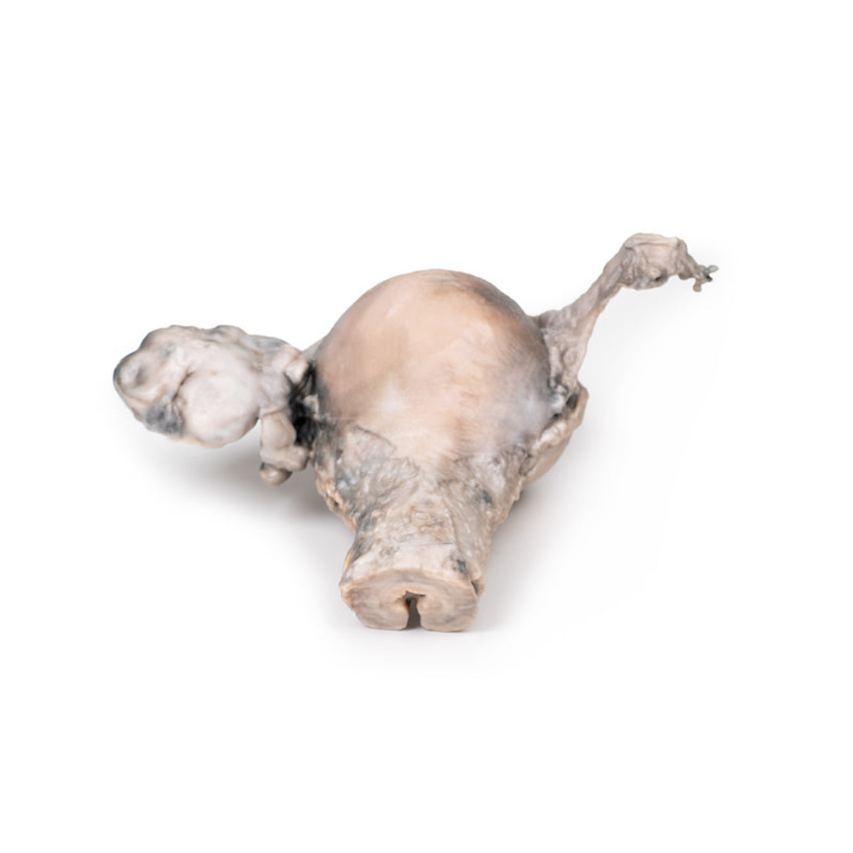 Endometrial Carcinoma | EZ-MP2106 | Sim & Skills Ltd