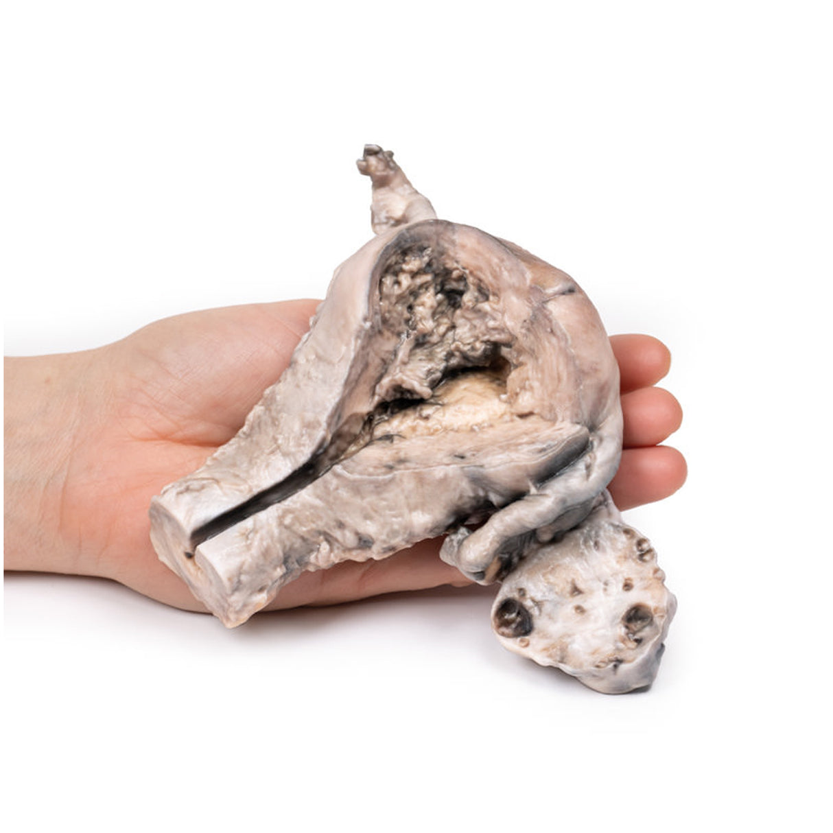 Endometrial Carcinoma | EZ-MP2106 | Sim & Skills Ltd