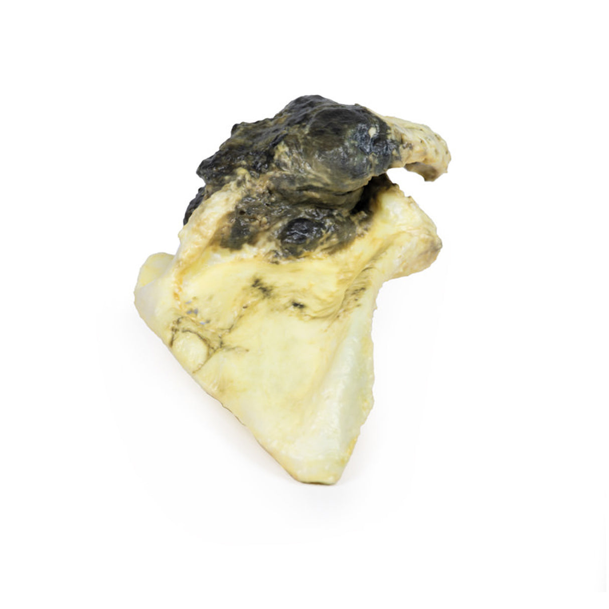 Chondrosarcoma of scapula | EZ-MP2114 | Sim & Skills Ltd