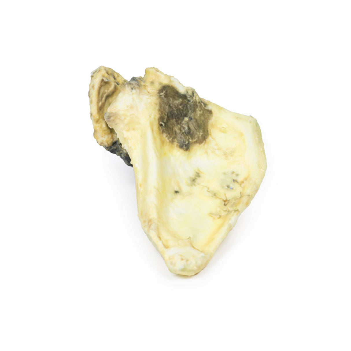 Chondrosarcoma of scapula | EZ-MP2114 | Sim & Skills Ltd