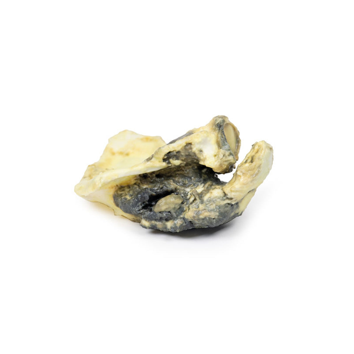 Chondrosarcoma of scapula | EZ-MP2114 | Sim & Skills Ltd