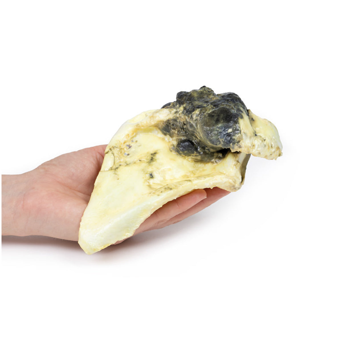 Chondrosarcoma of scapula | EZ-MP2114 | Sim & Skills Ltd