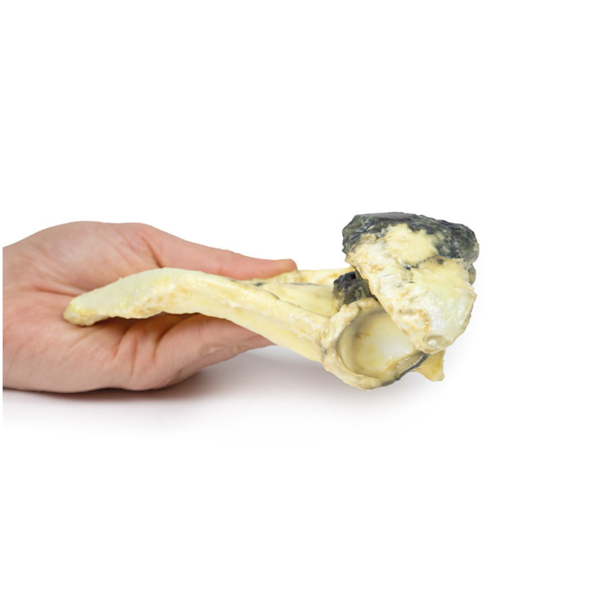 Chondrosarcoma of scapula | EZ-MP2114 | Sim & Skills Ltd