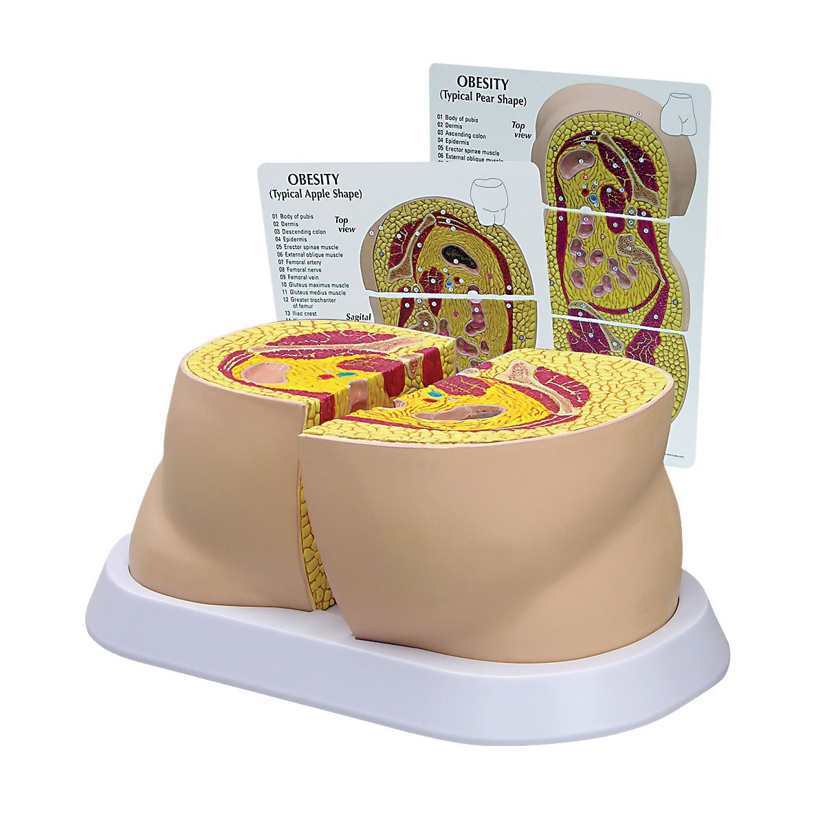 Obesity Model for Nutrition and Weight Loss Education 1019566 | Sim & Skills