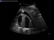 Transthoracic Echocardiography and Pericardiocentesis Ultrasound Training Model | BP-TTE1701-H | Blue Phantom | Sim & Skills