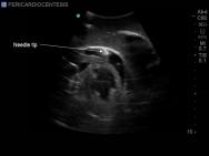 Transthoracic Echocardiography and Pericardiocentesis Ultrasound Training Model | BP-TTE1701-H | Blue Phantom | Sim & Skills