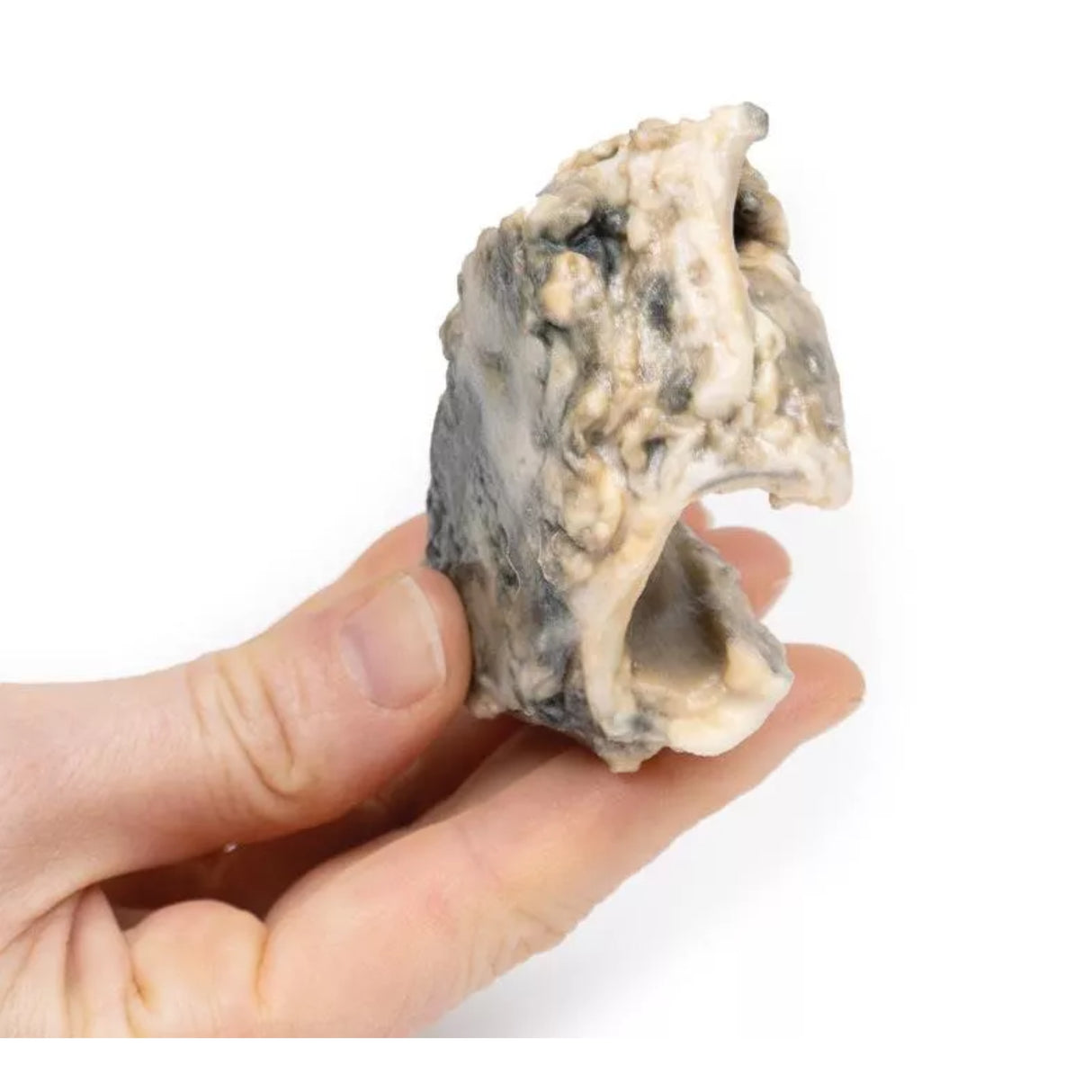 Carcinoma of Larynx| EZ-MP2052 | Sim & Skills Ltd